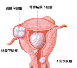 子宮肌瘤千萬(wàn)不能割，誰(shuí)割誰(shuí)后悔